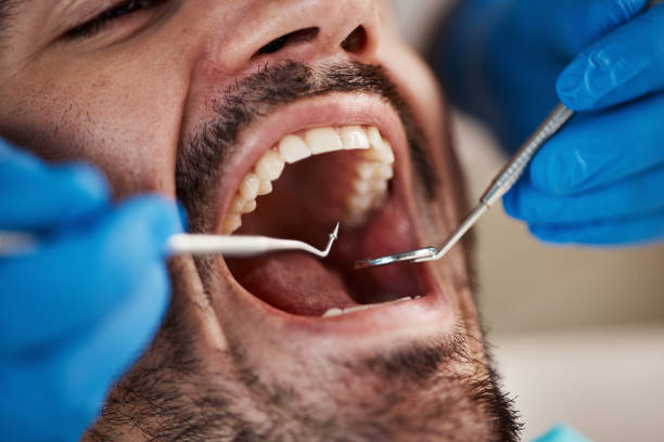 Best Emergency Dental Extractions in Weatherford, OK
